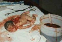 Abortusz Kép egy gyilkosságról